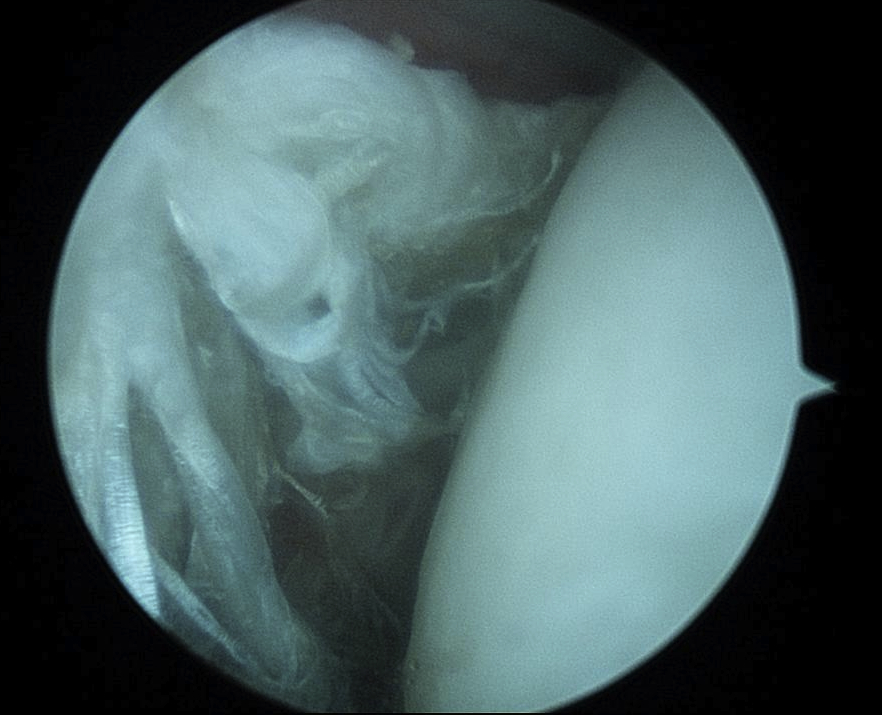 Biceps Tendonopathy Arhroscopy